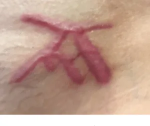 One DOS slave, whose initials just happened to be A-M, told Frank Report that when she initially saw her brand she thought it was her own initials that Dr. Danielle Porter branded upon her. Then when she read Frank Report, she realized that the initials were not hers, but Allison Mack's. She was horrified at the thought that she had both Keith Raniere's and Allison Mack's initials scarred upon her pubic area for life. She was not told in advance that this was going to happen and she was not told that Raniere was the secret head of DOS. But Allison Mack knew - and deliberately withheld this information.