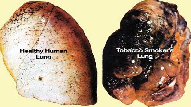 Report: Lung cancer victims in NY lead US in survival rate at 24%; Louisiana last at 15.9%