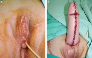 graphic phalloplasty vagina to penis trans surgery