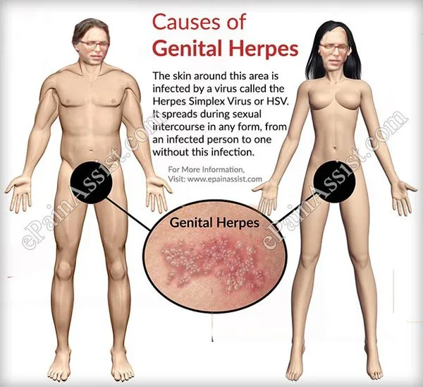 If he had it, Keith Raniere would not have been timid about sharing his herpes with his harem.