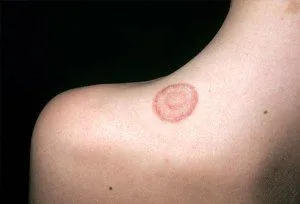 Ringworm on Shoulder
