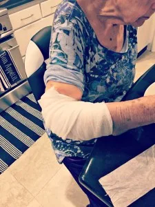 The elbow injury.
