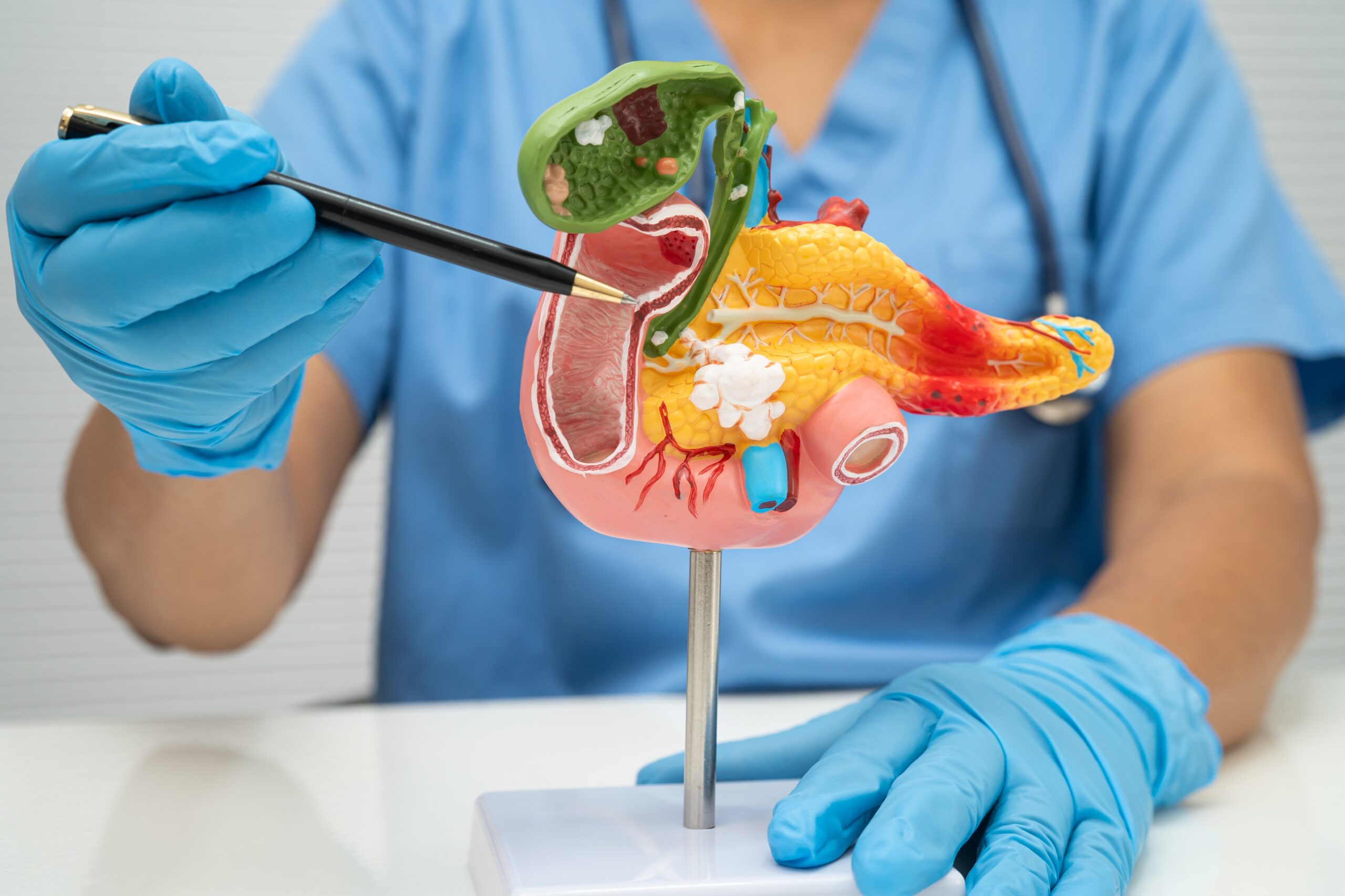 Pancreatic Cancer Drug Daraxonrasib Nearly Doubled Survival In Phase 3