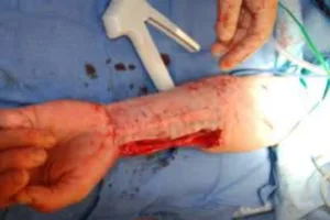 phalloplasty arm surgery trans