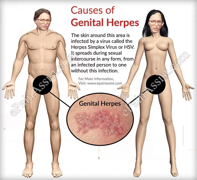 What everyone at V-Week should know about herpes and V                               (VÉASE ABAJO PARA LA TRADUCCIÓN EN ESPAÑOL)