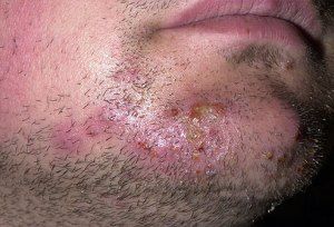 Ringworm of the Beard