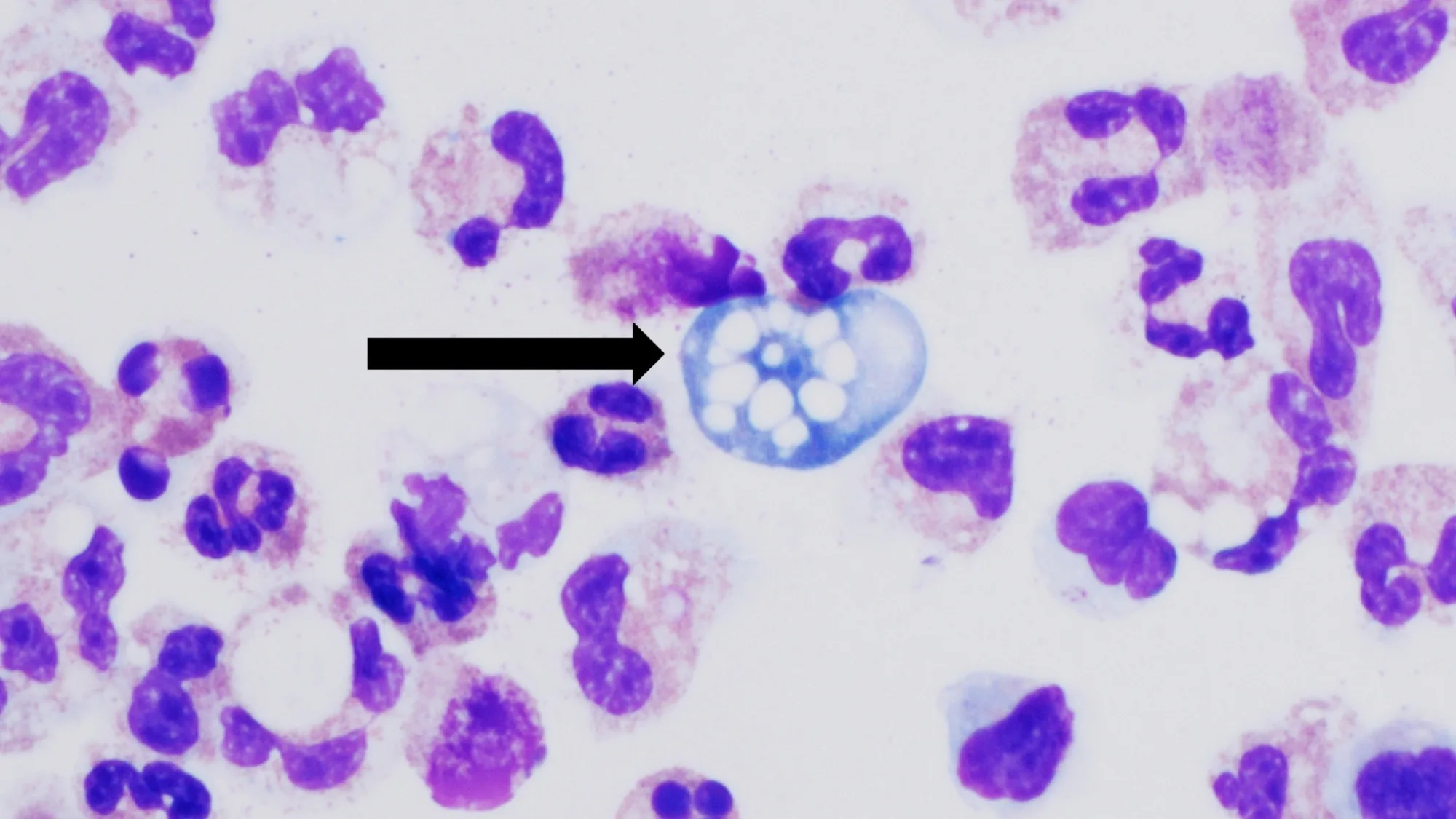 Brain Eating Amoeba Kills A 17-Year-Old After He Splashed Water On His Face At A Durham Community Center
